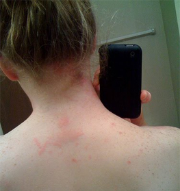 bed bug bites